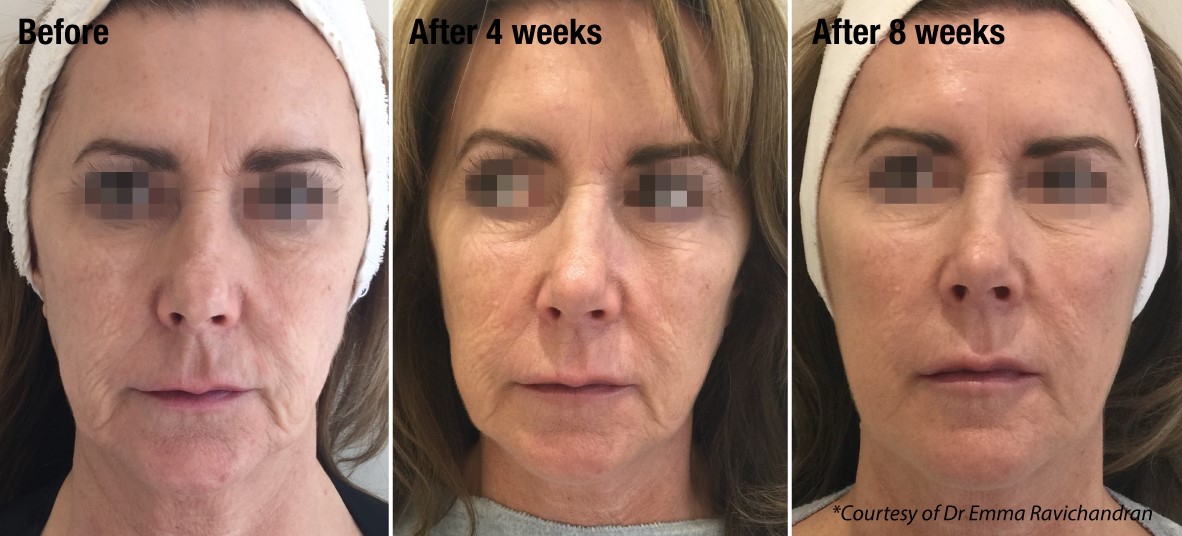 Profhilo Before and After - Dundrum Cosmetic Clinic